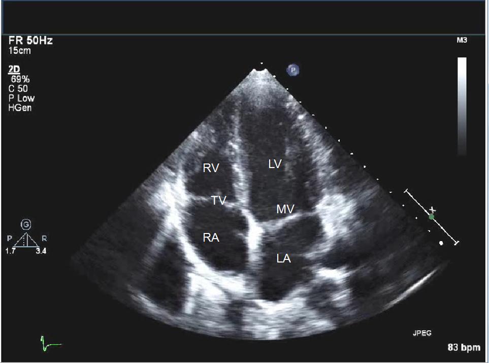 abnormal echocardiogram results