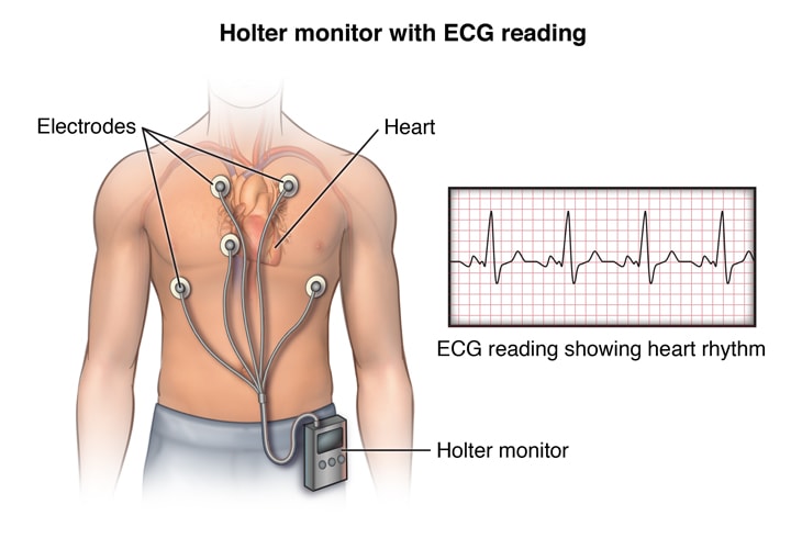 Holter Monitor Test Cost, Holter Heart Monitor